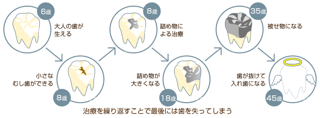歯を失う過程