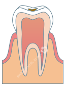 C1：エナメル質の虫歯