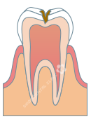 C2：象牙質の虫歯