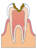 C3：神経にまで達した虫歯