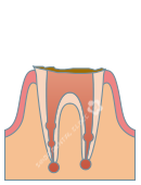 C4：歯根にまで達した虫歯