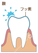 フッ素塗布